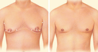 Breast Reduction - Ira Krafchin MD PC