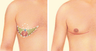 Breast Lift for Men (Nipple Position) - iMed Medical