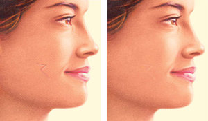 side scar