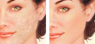 cheek scar